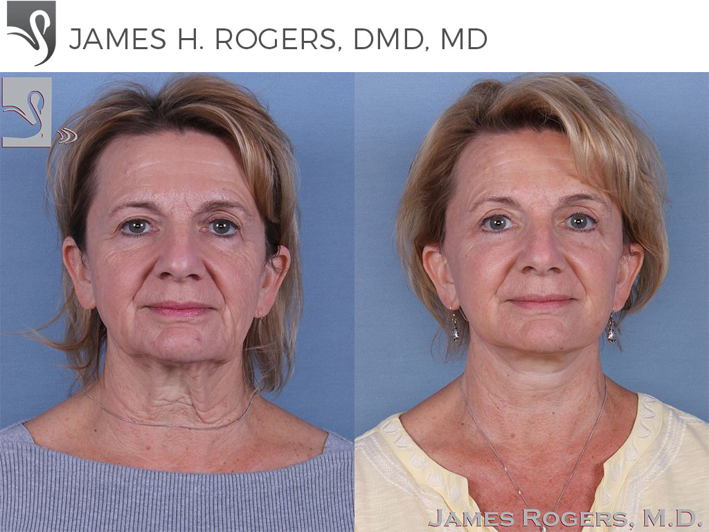 Before and After Image: Face Lift Case #45284 - front