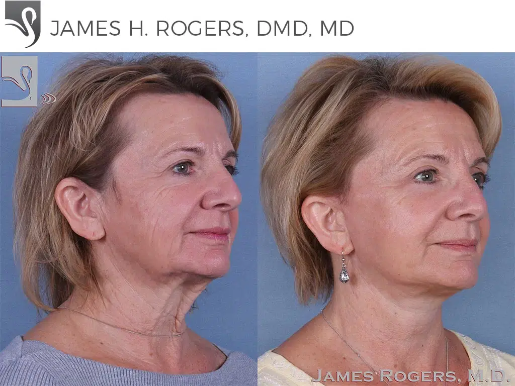 Before and After Image: Face Lift Case #45284 - right-front-oblique
