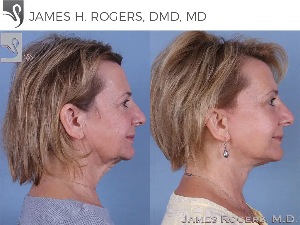 Before and After Image: Face Lift Case #45284 - right-side