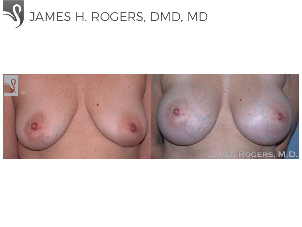Before and After Image: Breast Augmentation Case #45650 - front