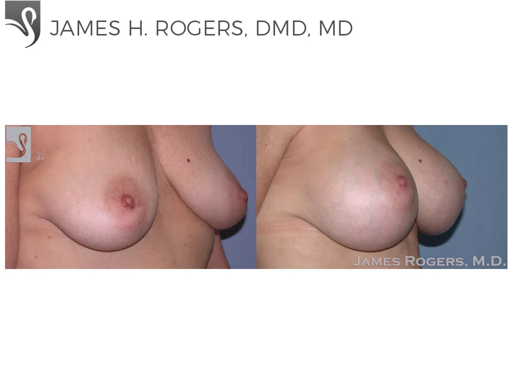 Before and After Image: Breast Augmentation Case #45650 - right-front-oblique