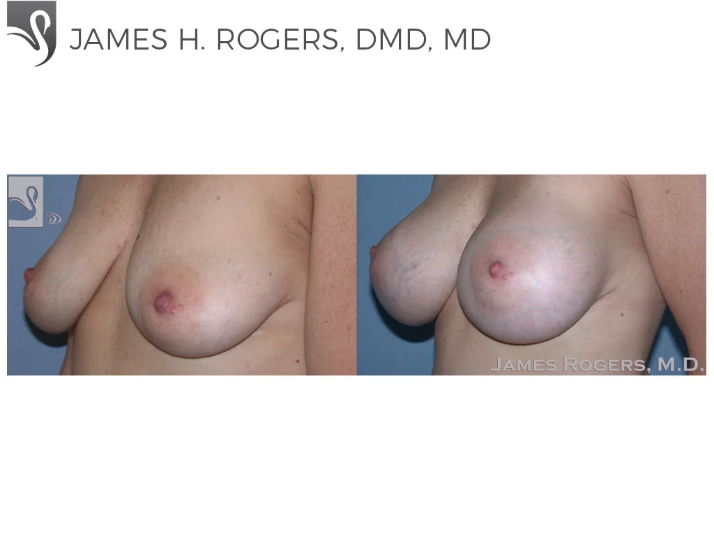 Before and After Image: Breast Augmentation Case #45650 - left-front-oblique