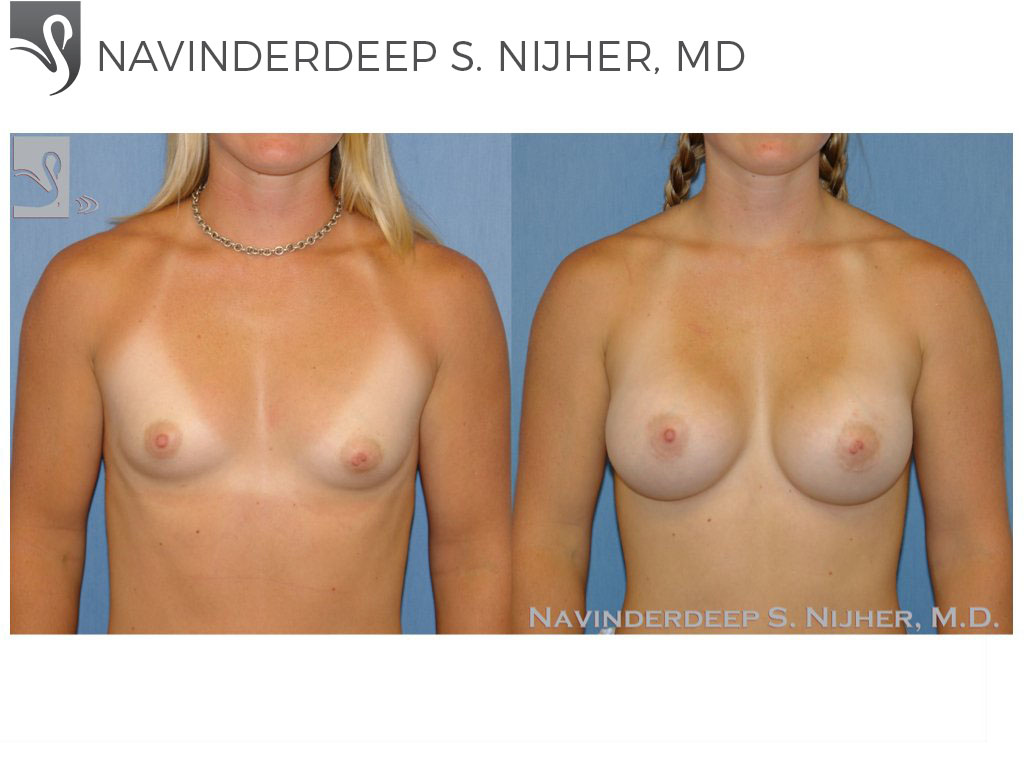Before and After Image: Breast Augmentation Case #45958 - front