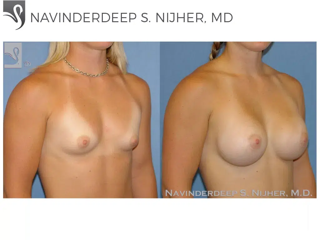 Before and After Image: Breast Augmentation Case #45958 - right-front-oblique