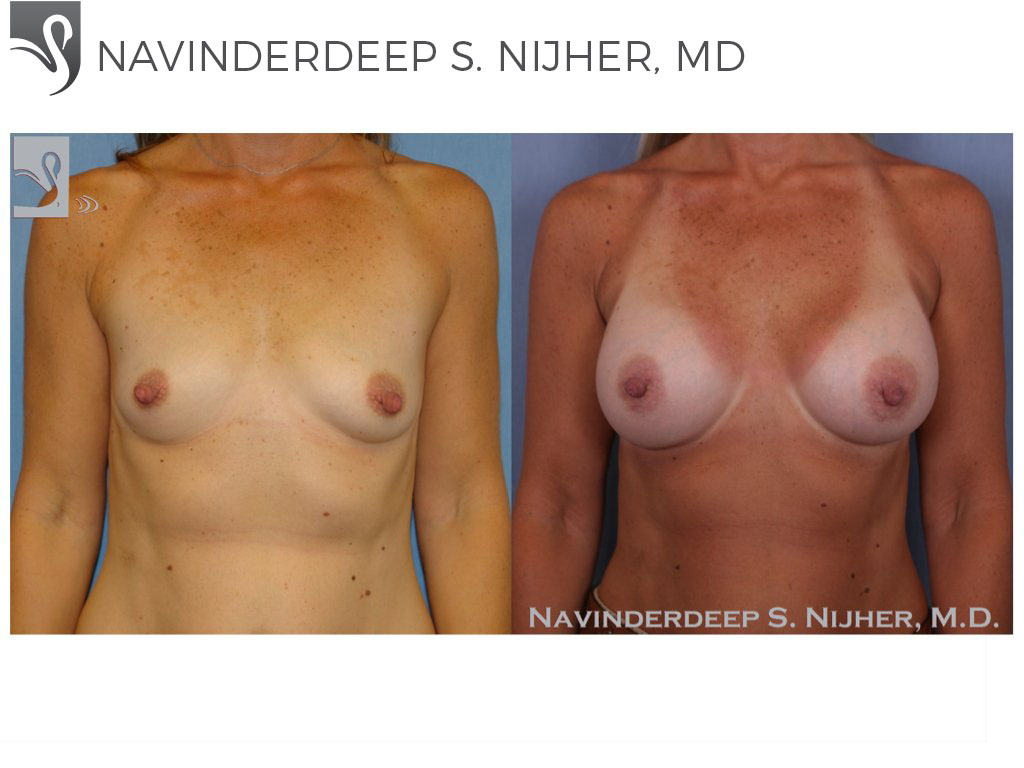 Before and After Image: Breast Augmentation Case #46123 - front