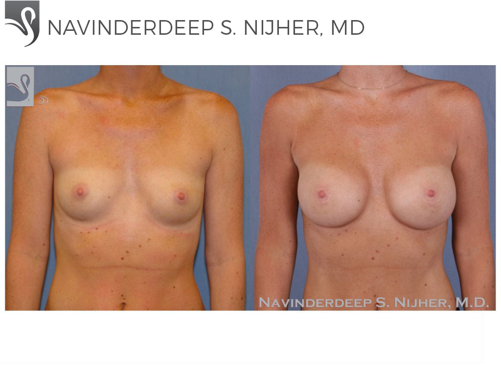 Before and After Image: Breast Augmentation Case #46582 - front