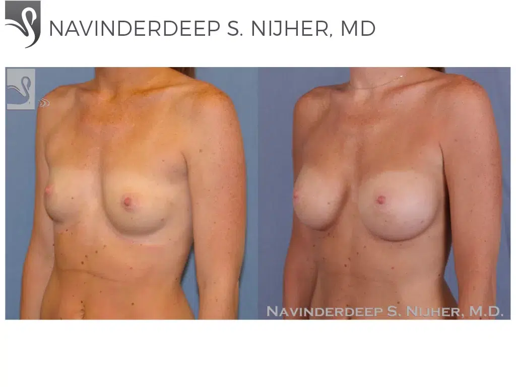 Before and After Image: Breast Augmentation Case #46582 - left-front-oblique