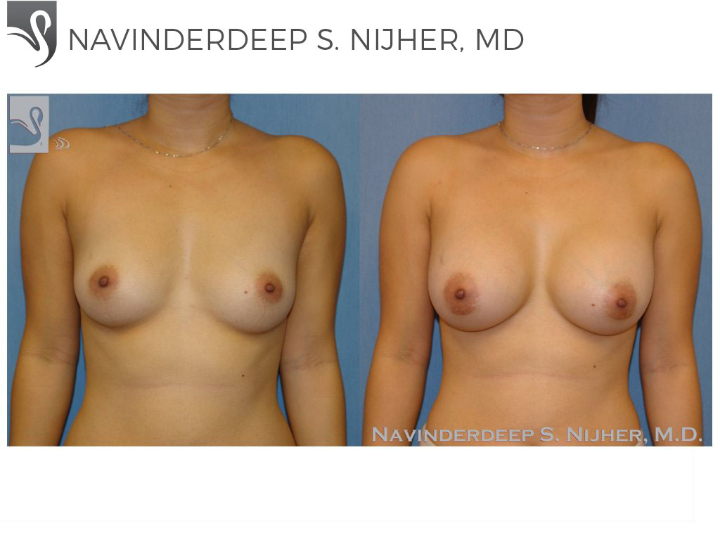 Before and After Image: Breast Augmentation Case #46627 - front