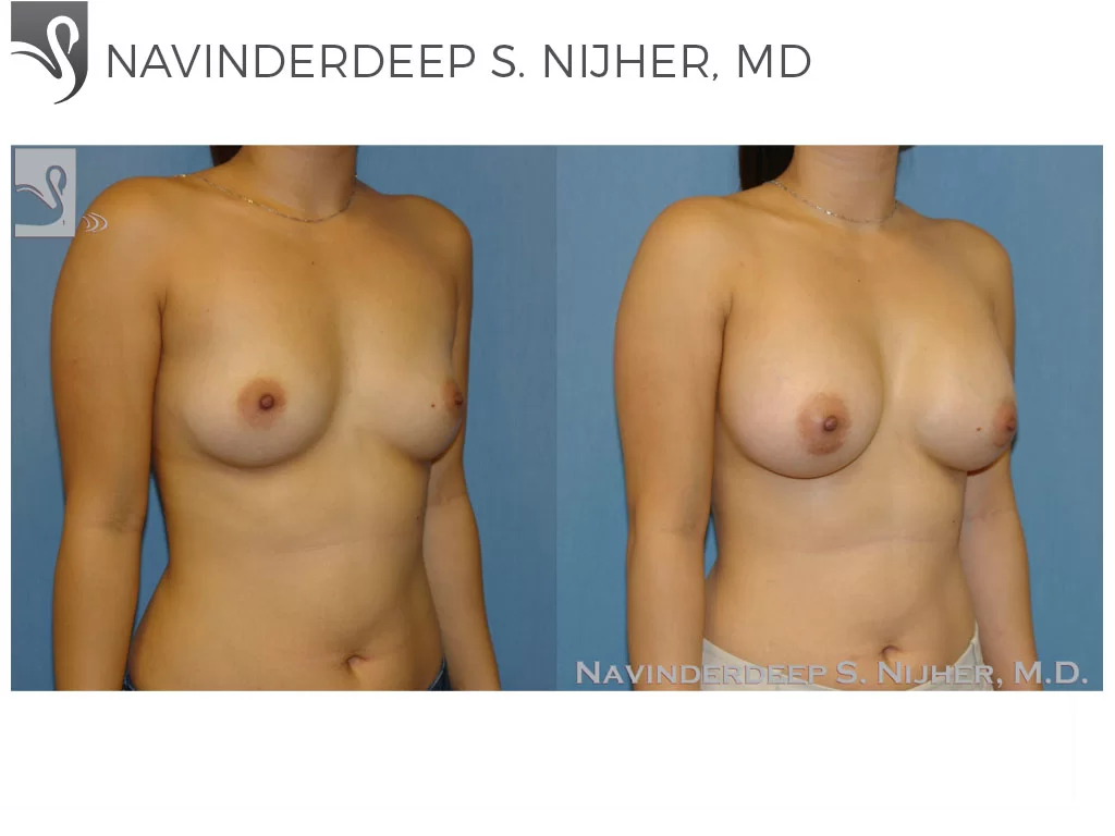 Before and After Image: Breast Augmentation Case #46627 - right-front-oblique