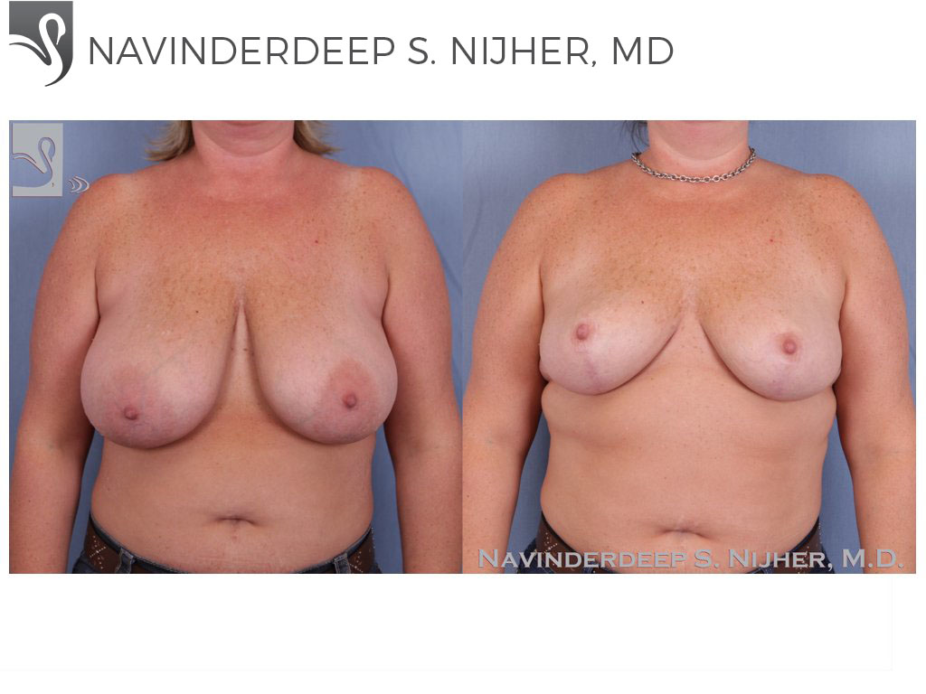 Before and After Image: Female Breast Reduction Case #46888 - front