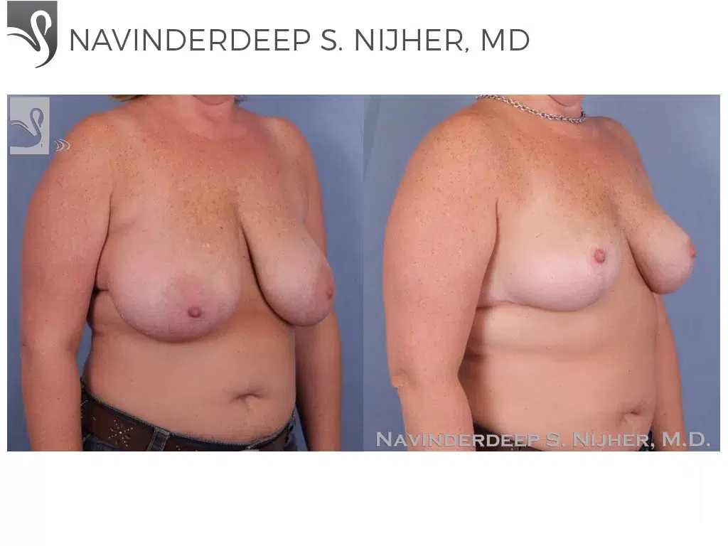 Before and After Image: Female Breast Reduction Case #46888 - right-front-oblique