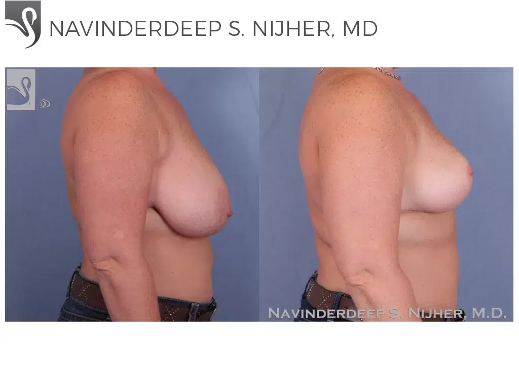 Before and After Image: Female Breast Reduction Case #46888 - right-side