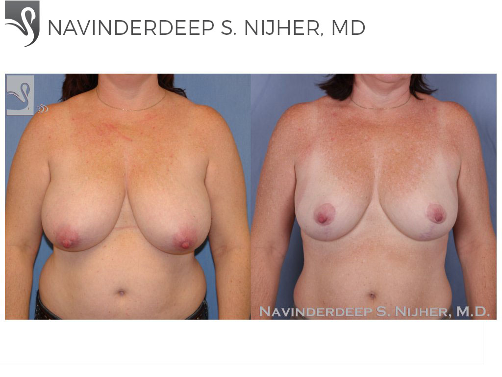 Before and After Image: Female Breast Reduction Case #47307 - front