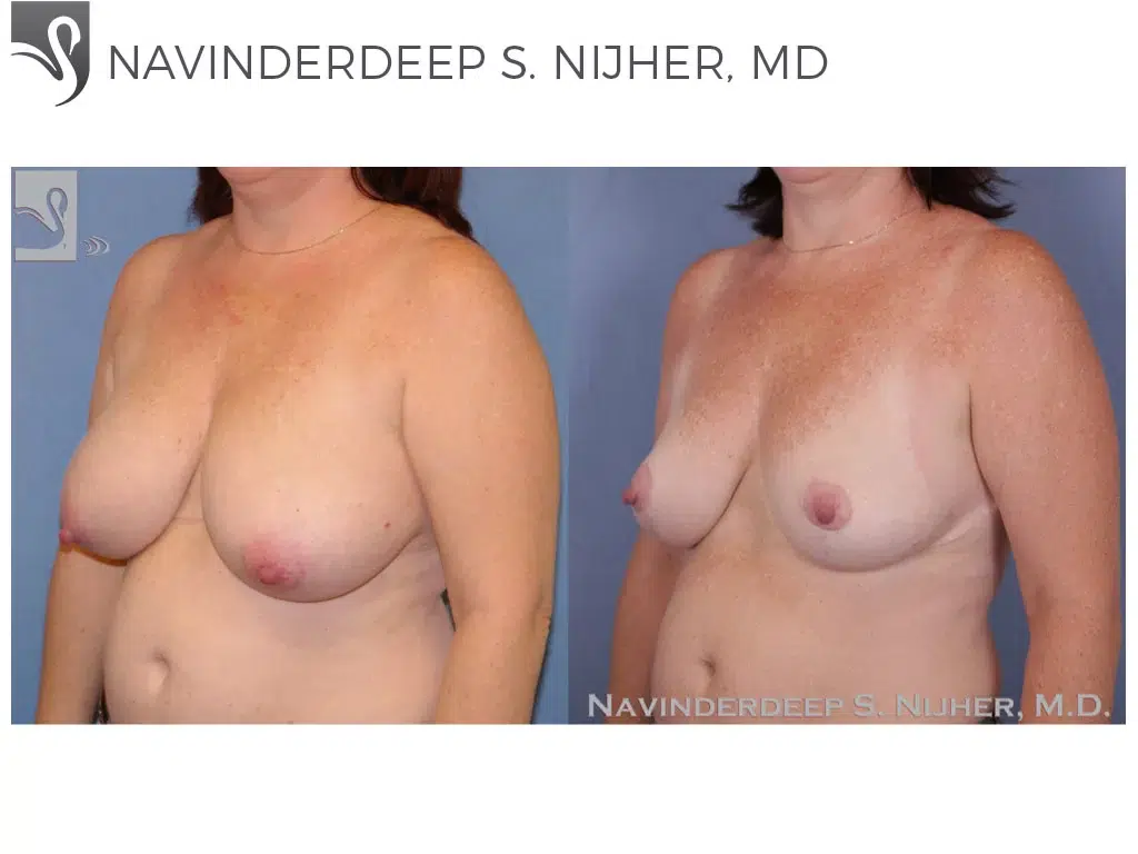 Before and After Image: Female Breast Reduction Case #47307 - left-front-oblique