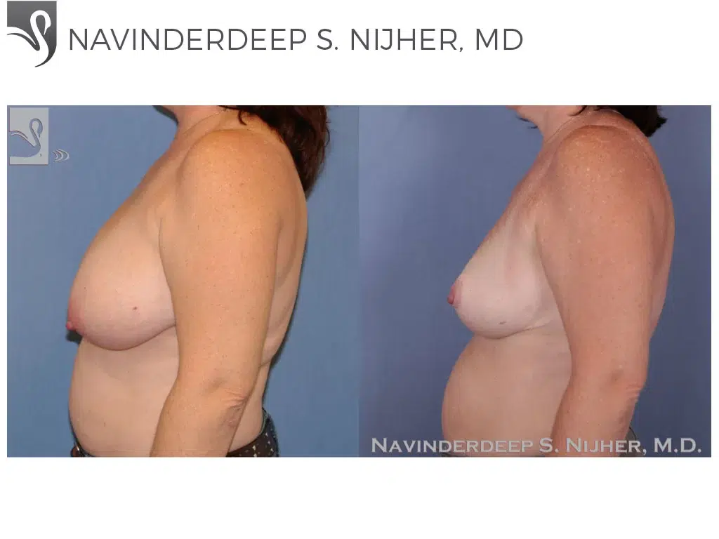 Before and After Image: Female Breast Reduction Case #47307 - left-side