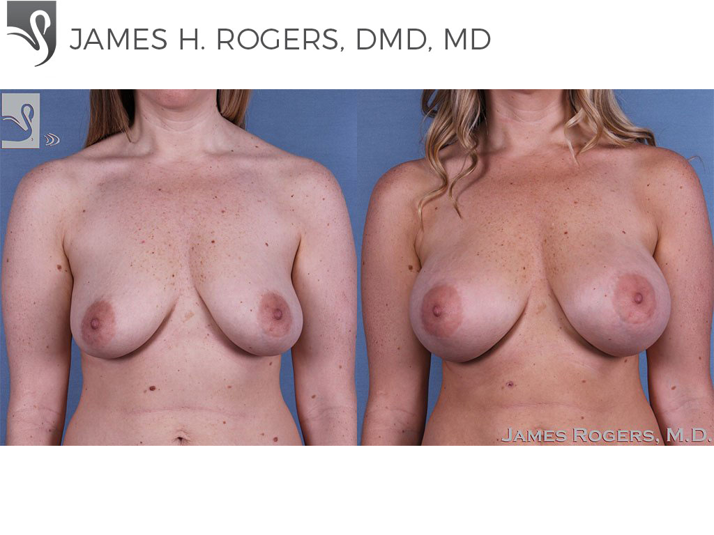 Before and After Image: Breast Augmentation Case #47135 - front