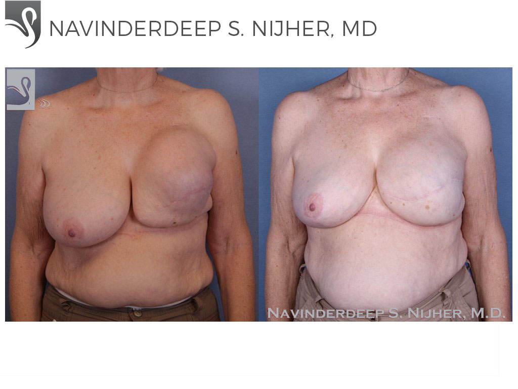 Before and After Image: Breast Reconstruction Case #47453 - front
