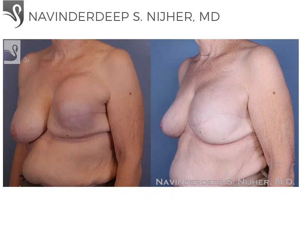 Before and After Image: Breast Reconstruction Case #47453 - left-front-oblique