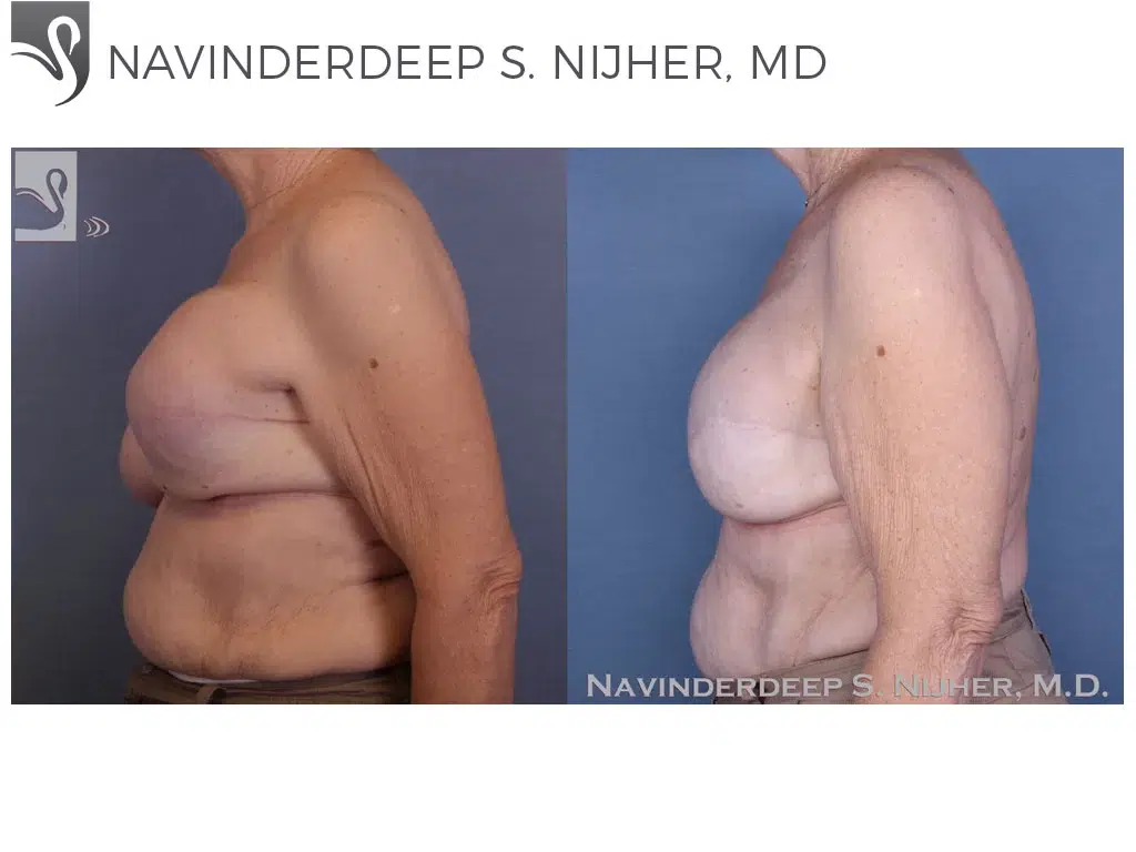 Before and After Image: Breast Reconstruction Case #47453 - left-side