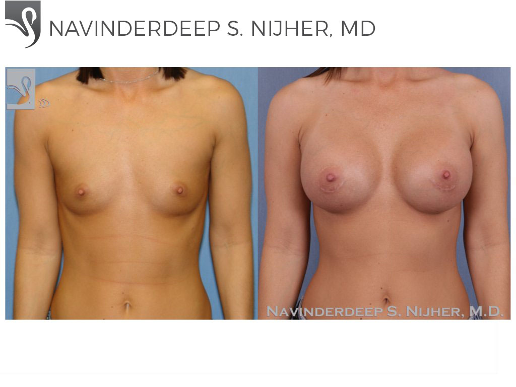 Before and After Image: Breast Augmentation Case #47576 - front