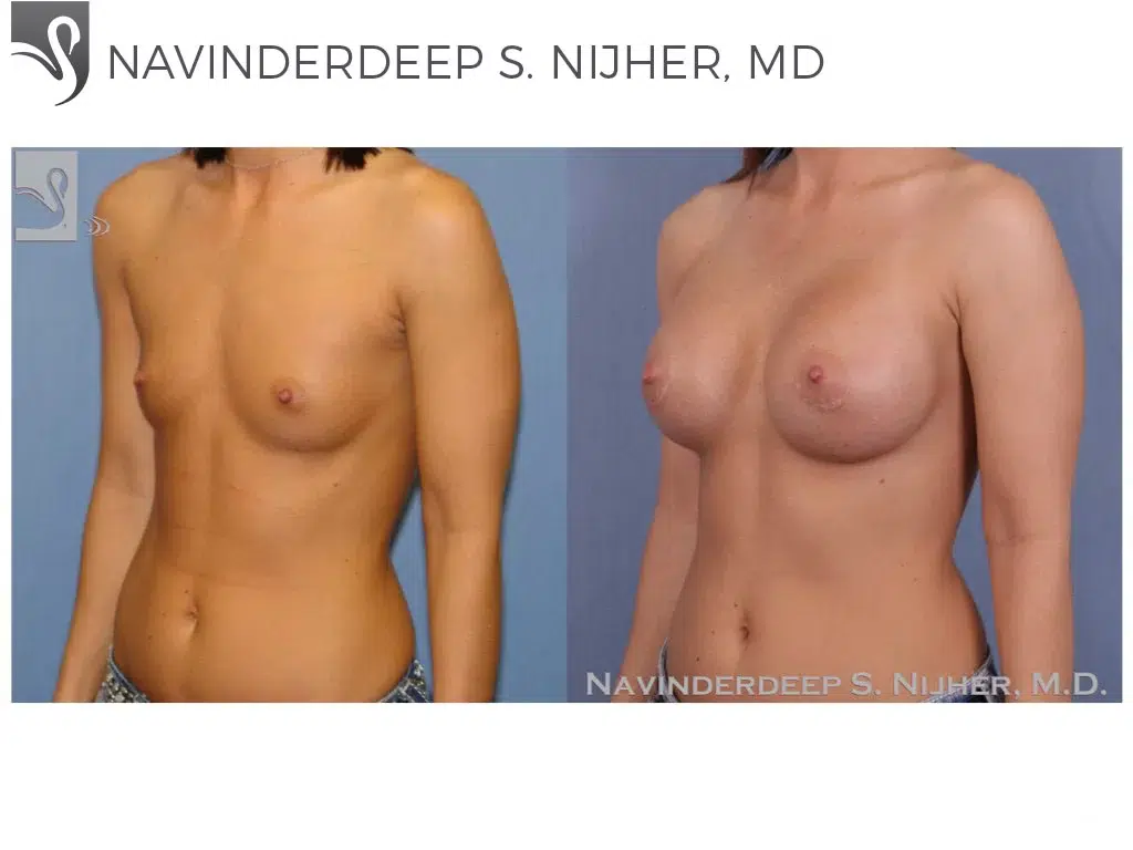 Before and After Image: Breast Augmentation Case #47576 - left-front-oblique