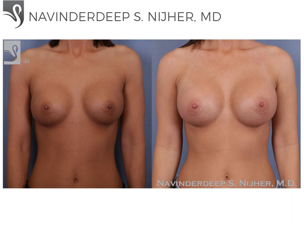Before and After Image: Breast Revisions Case #47576 - front