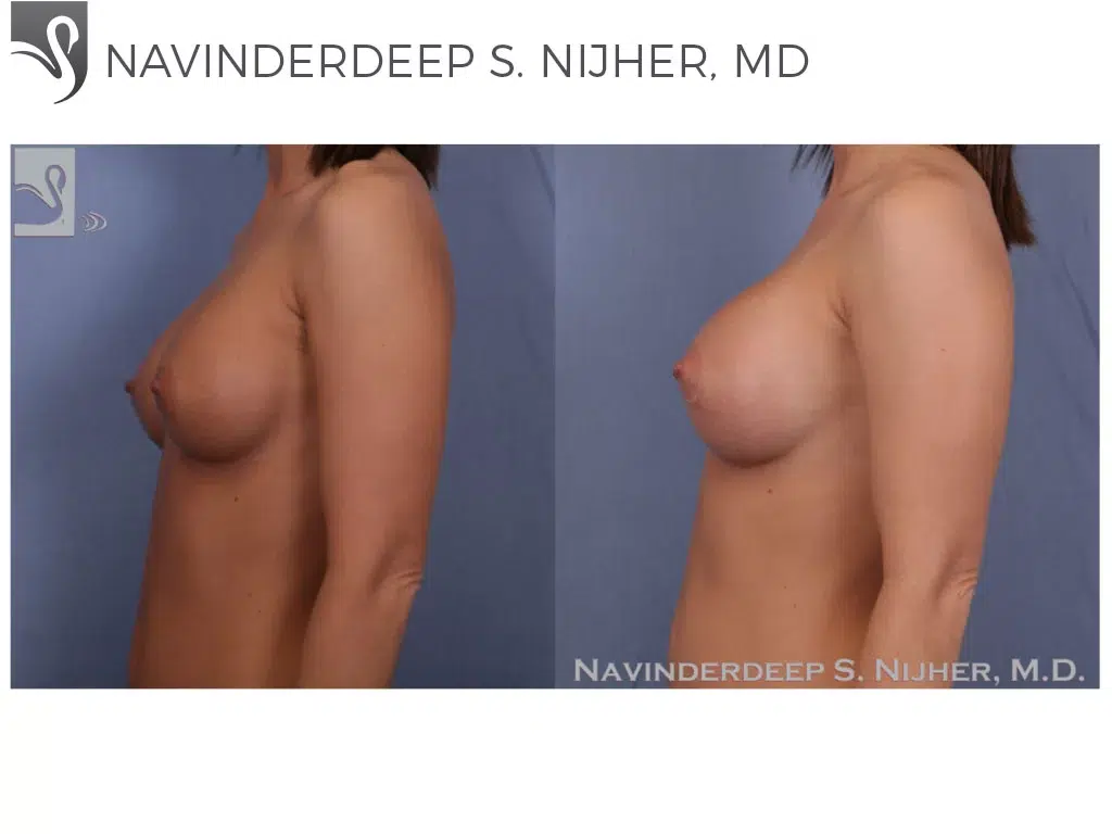 Before and After Image: Breast Revisions Case #47576 - left-side