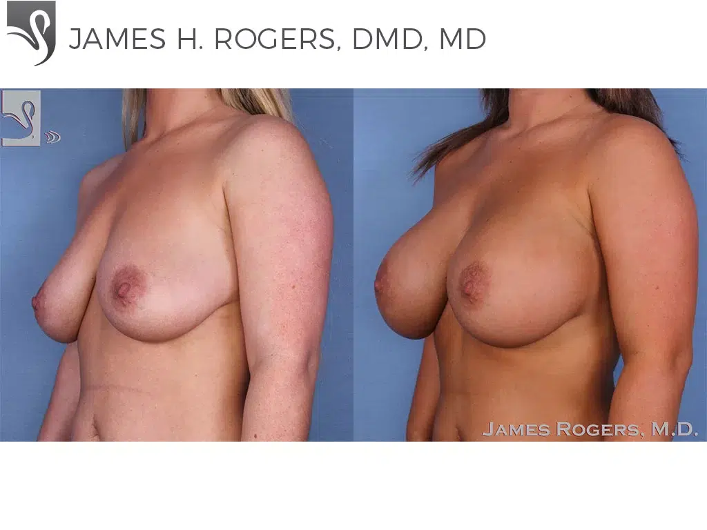 Before and After Image: Breast Augmentation Case #47717 - left-front-oblique