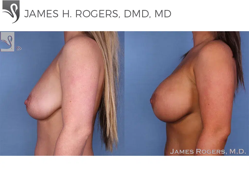 Before and After Image: Breast Augmentation Case #47717 - left-side