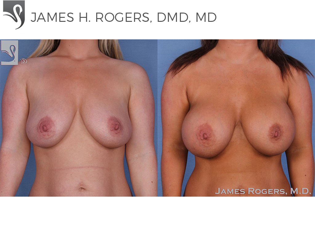 Before and After Image: Breast Augmentation Case #47717 - front