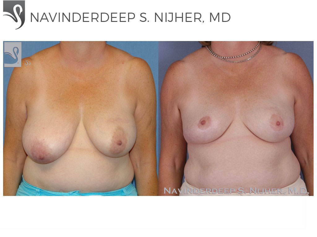 Before and After Image: Breast Lift (Mastopexy) Case #47753 - front