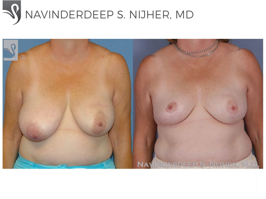 Before and After Image: Breast Reconstruction Case #47753 - front
