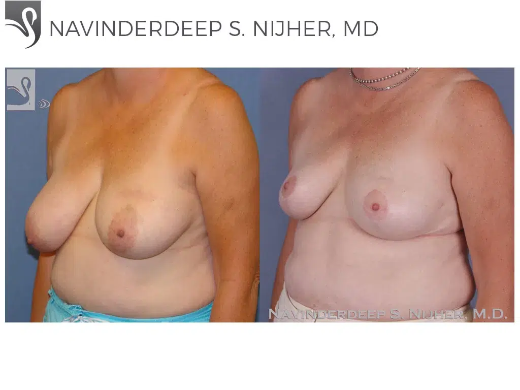 Before and After Image: Female Breast Reduction Case #47753 - left-front-oblique