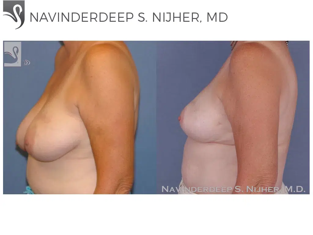 Before and After Image: Female Breast Reduction Case #47753 - left-side