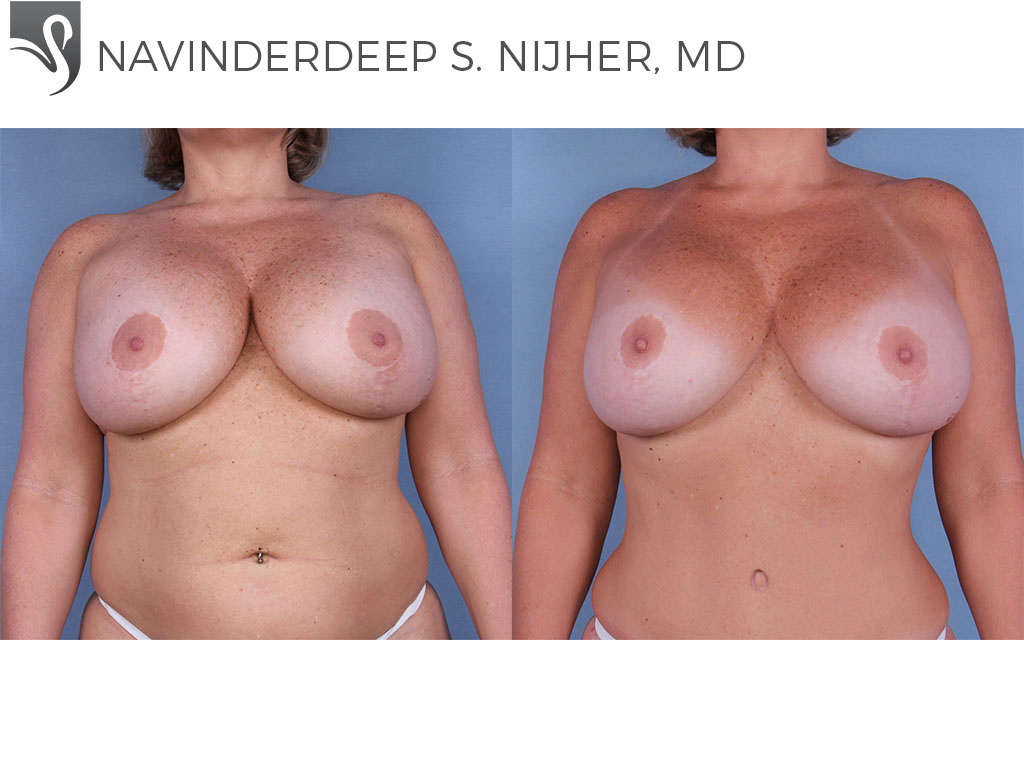 Before and After Image: Breast Revisions Case #47923 - front