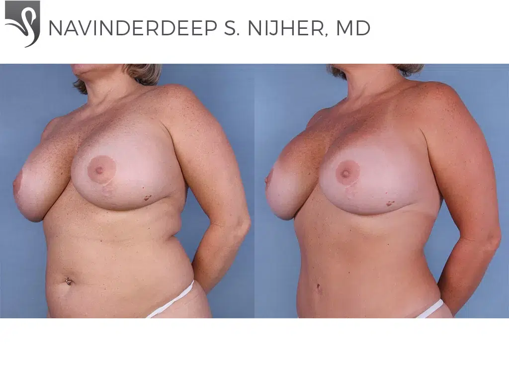 Before and After Image: Breast Revisions Case #47923 - left-front-oblique