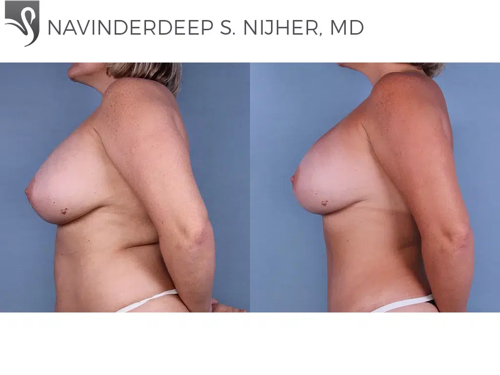 Before and After Image: Breast Revisions Case #47923 - left-side