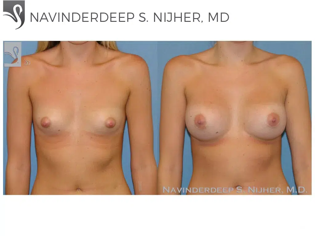 Before and After Image: Breast Augmentation Case #48014 - front