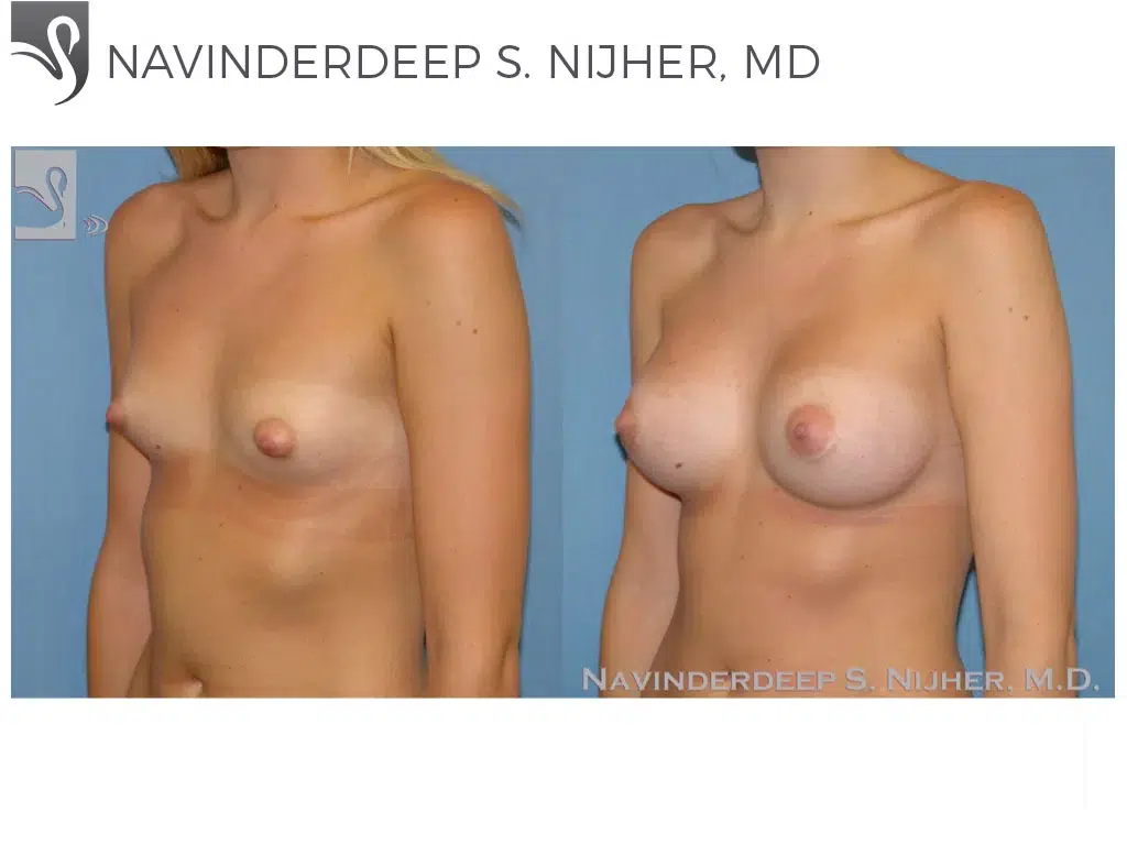 Before and After Image: Breast Augmentation Case #48014 - left-front-oblique