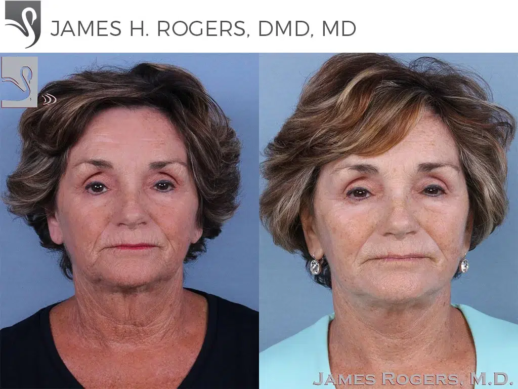 Before and After Image: Face Lift Case #48163 - front