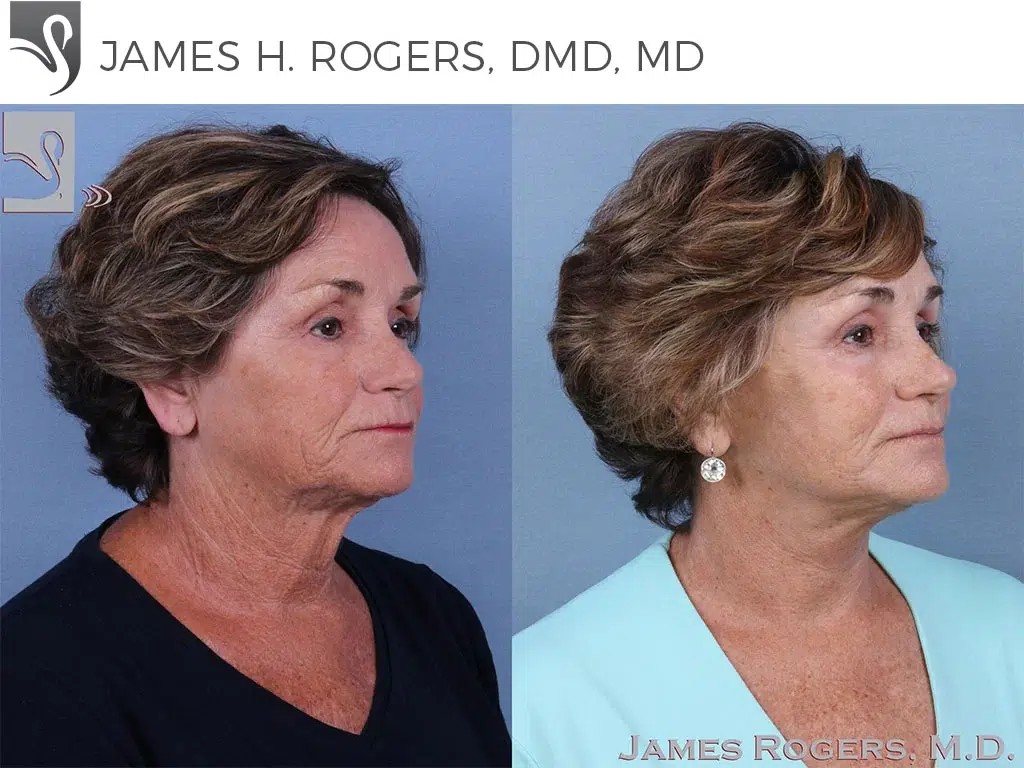 Before and After Image: Face Lift Case #48163 - right-front-oblique