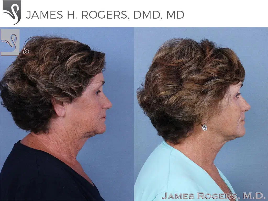 Before and After Image: Face Lift Case #48163 - right-side