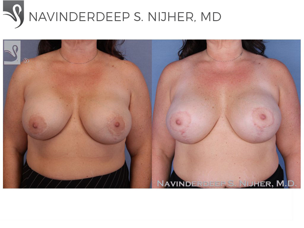 Before and After Image: Breast Revisions Case #48262 - front