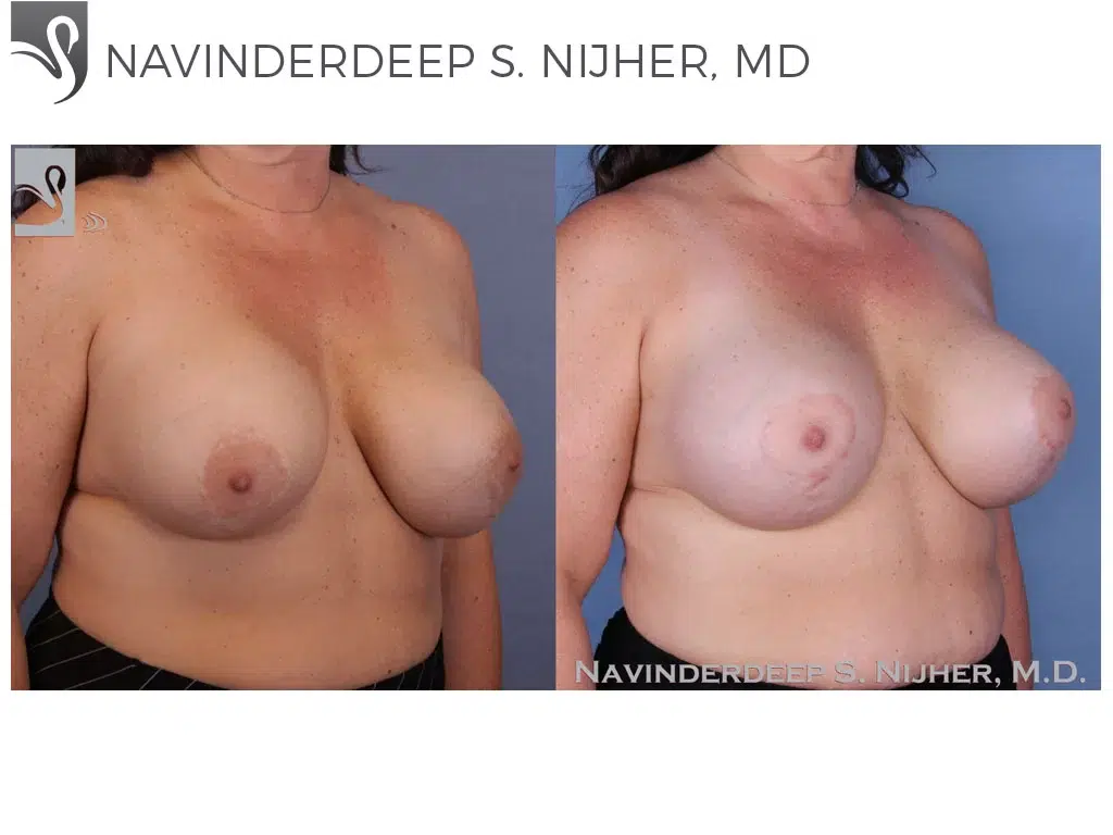 Before and After Image: Breast Revisions Case #48262 - right-front-oblique