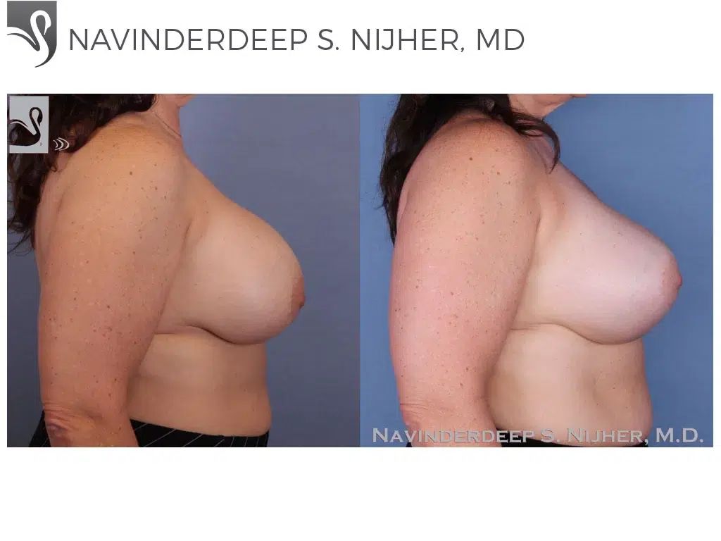 Before and After Image: Breast Revisions Case #48262 - right-side