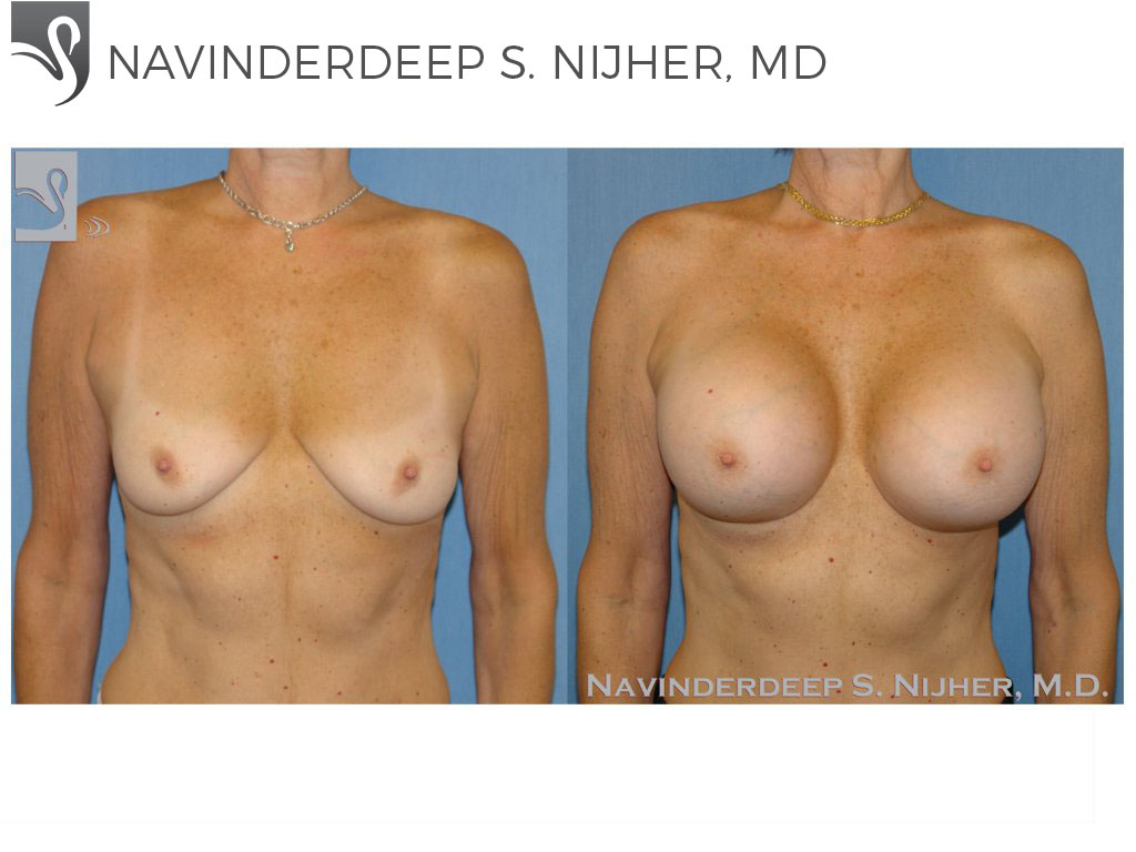 Before and After Image: Breast Augmentation Case #48309 - front