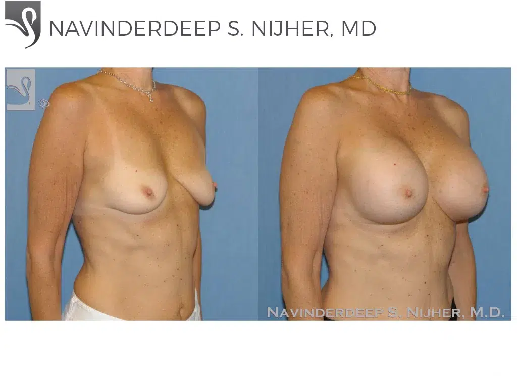 Before and After Image: Breast Augmentation Case #48309 - right-front-oblique