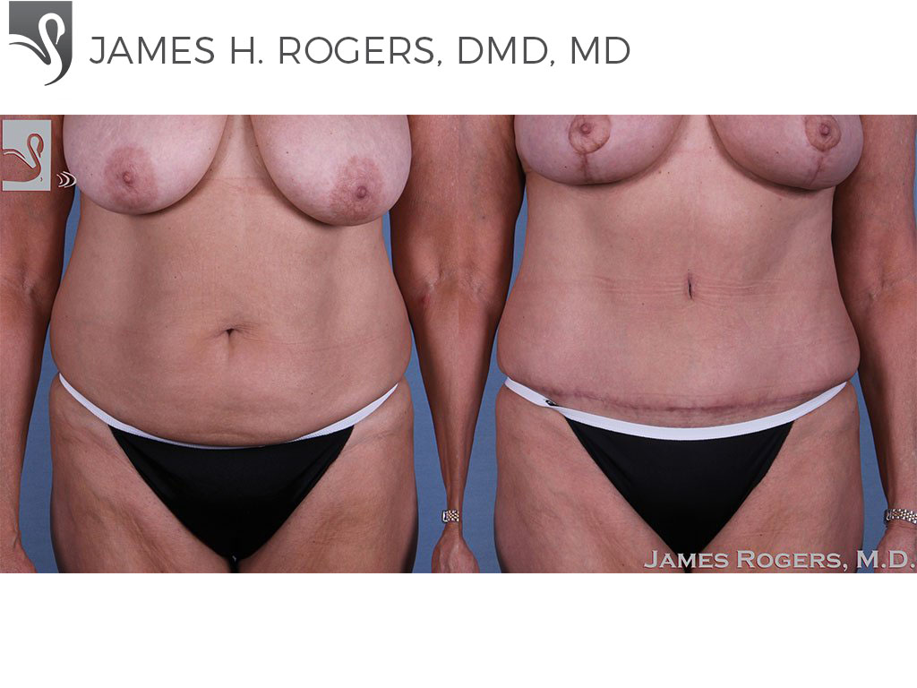 Before and After Image: Abdominoplasty (Tummy Tuck) Case #48358 - front