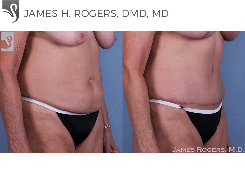 Before and After Image: Abdominoplasty (Tummy Tuck) Case #48358 - right-front-oblique