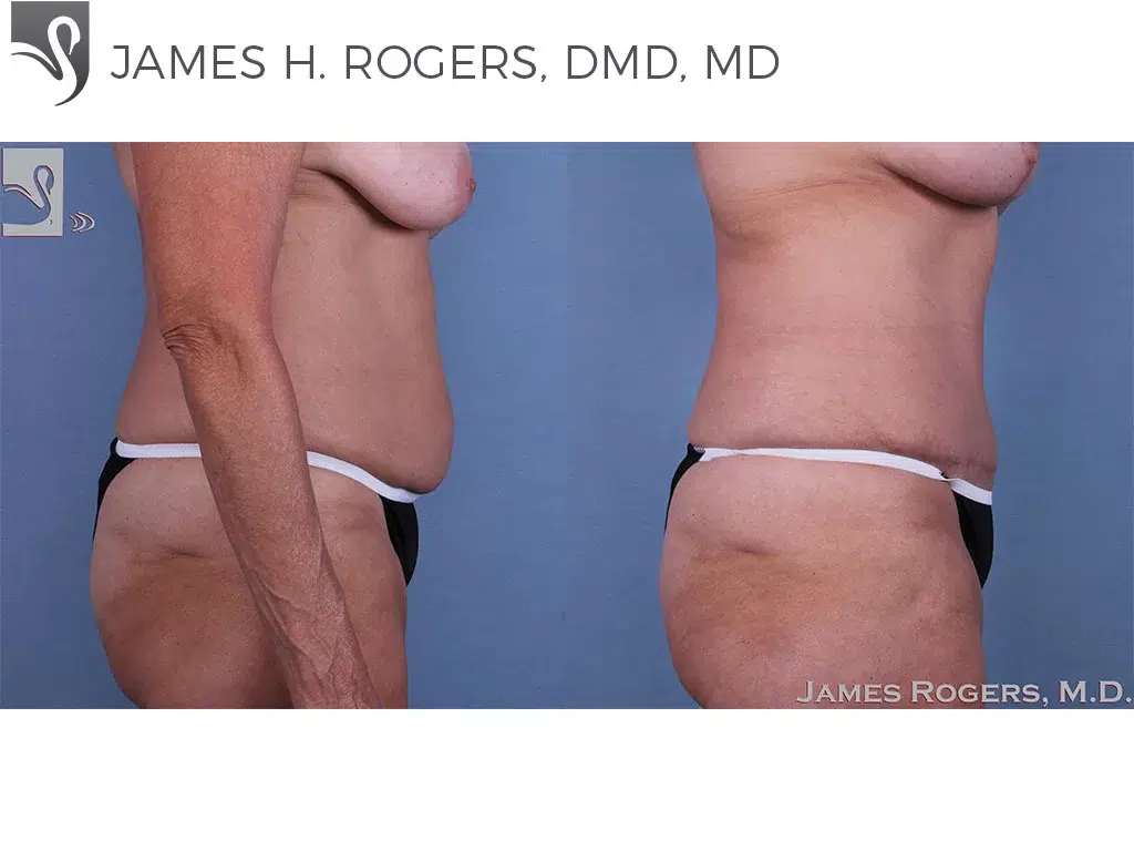 Before and After Image: Abdominoplasty (Tummy Tuck) Case #48358 - right-side